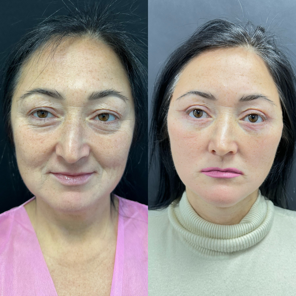 46 лет , 2 недели после операции ( Смас ПОДТЯЖКА лица и шеи , пластика век) , фотография 1