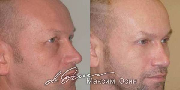 Фото пациента до и после круговой блефаропластики.
, фотография 3