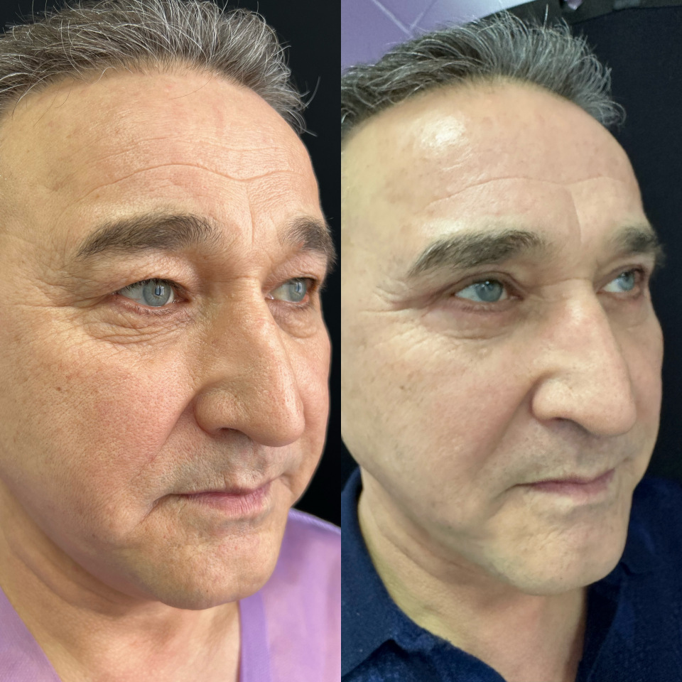 Круговая блефаропластика до и после . Месяц с момента операции, фотография 2