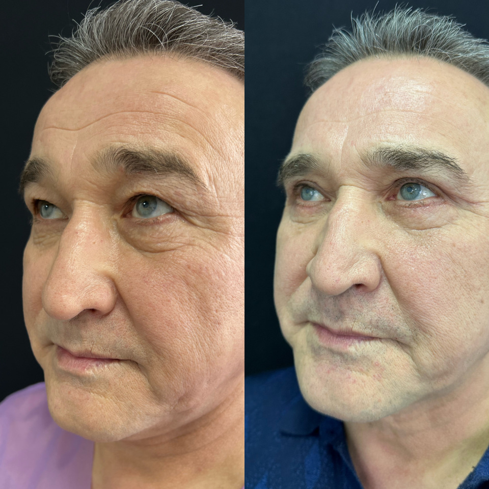 Круговая блефаропластика до и после . Месяц с момента операции, фотография 3