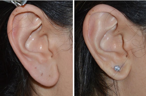 Пластическая операция на мочке уха  — хирург Осин М.А. 05.02.2019, фотография 1