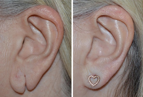 Пластическая операция на мочке уха  — хирург Осин М.А. 15.04.2019, фотография 1