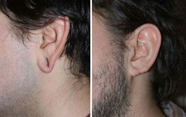 Пластическая операция на мочке уха  — хирург Осин М.А. 28.05.2019, фотография 1