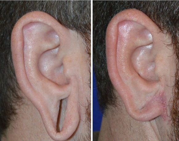 Пластическая операция на мочке уха  — хирург Осин М.А. 17.04.2019, фотография 1