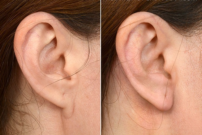 Пластическая операция на мочке уха  — хирург Осин М.А. 05.08.2019, фотография 1