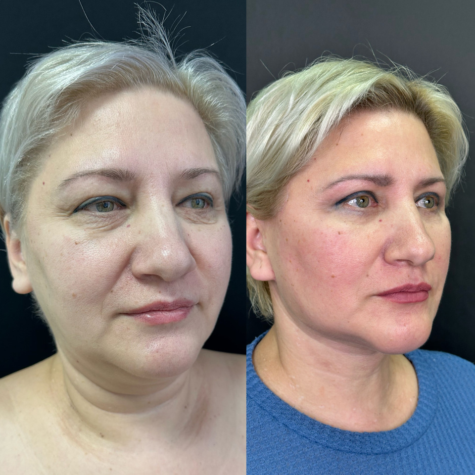 подтяжка лица . Фото до и после , фотография 3 подтяжка лица . Фото до и после , фотография 3