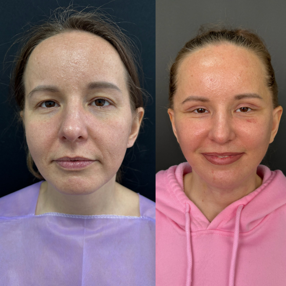 Подтяжка лица до 40 лет . Фото до и после , фотография 1 Подтяжка лица до 40 лет . Фото до и после , фотография 1