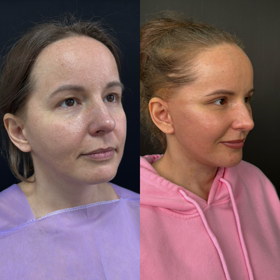 Подтяжка лица до 40 лет . Фото до и после , фотография 3 Подтяжка лица до 40 лет . Фото до и после , фотография 3