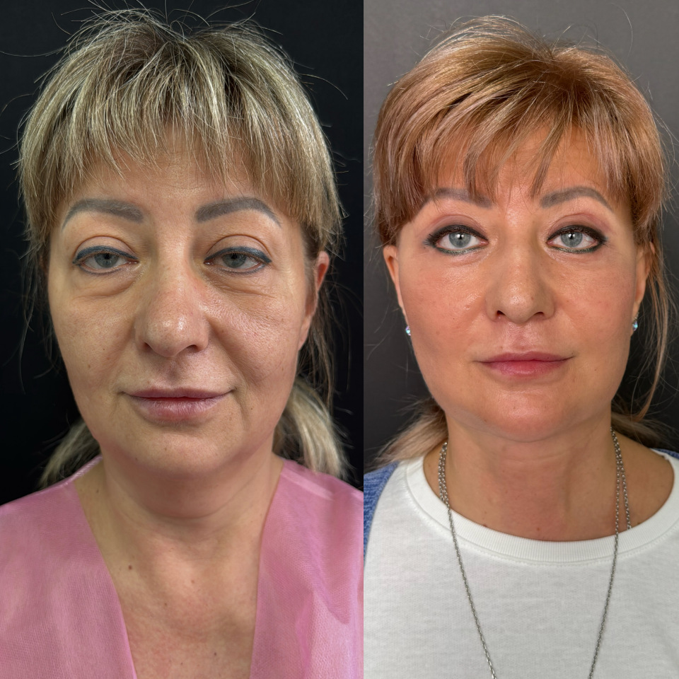 Фейслифтинг . Фото до и после , фотография 1 Фейслифтинг . Фото до и после , фотография 1