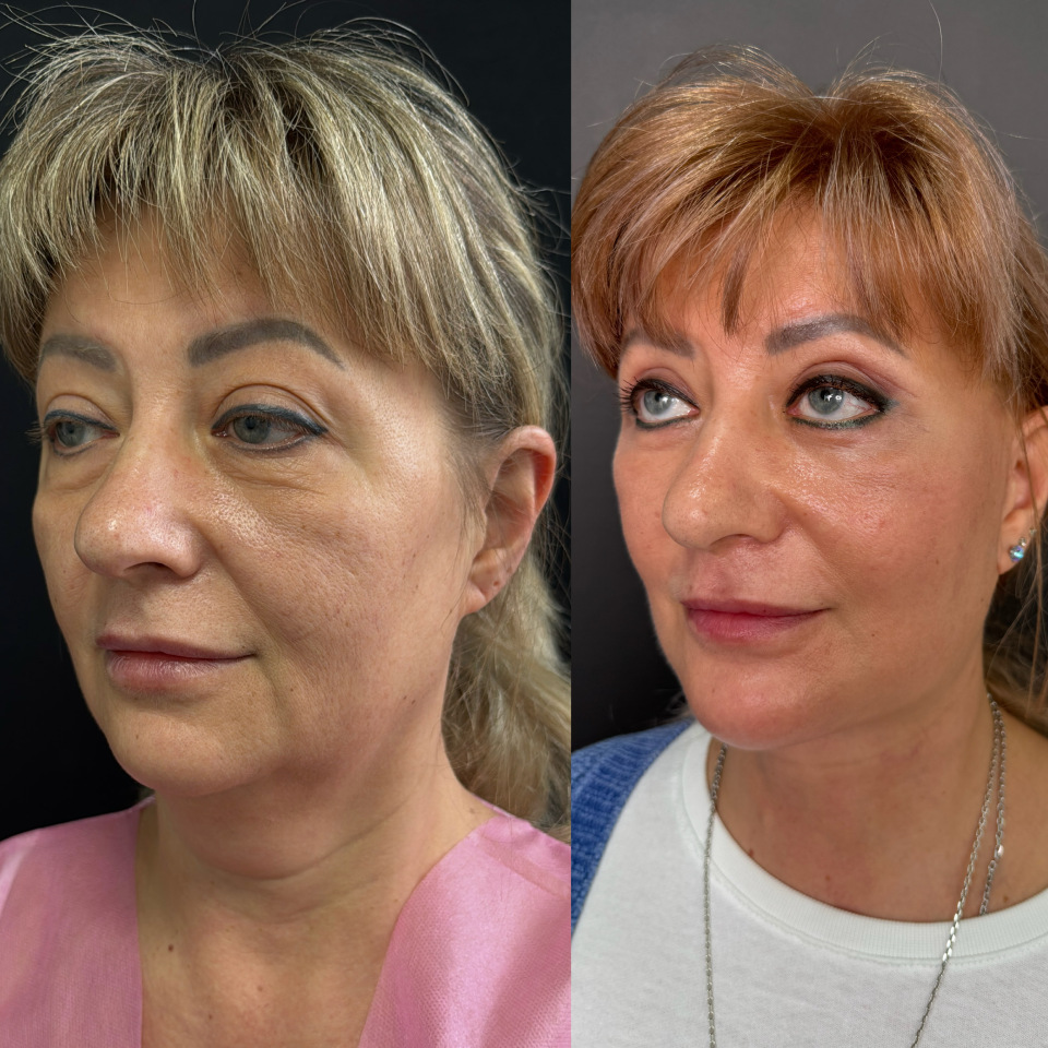 Фейслифтинг . Фото до и после , фотография 2 Фейслифтинг . Фото до и после , фотография 2