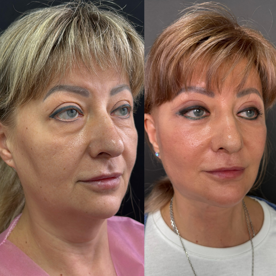 Фейслифтинг . Фото до и после , фотография 3 Фейслифтинг . Фото до и после , фотография 3