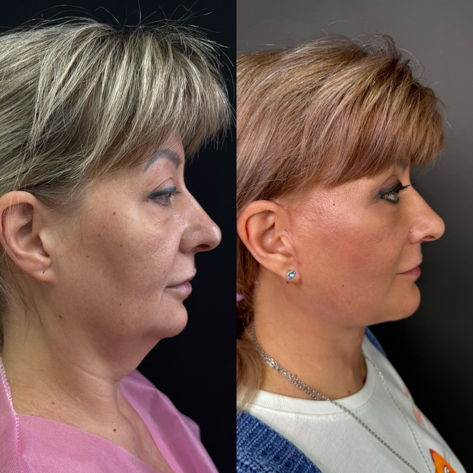 Фейслифтинг . Фото до и после , фотография 4 Фейслифтинг . Фото до и после , фотография 4