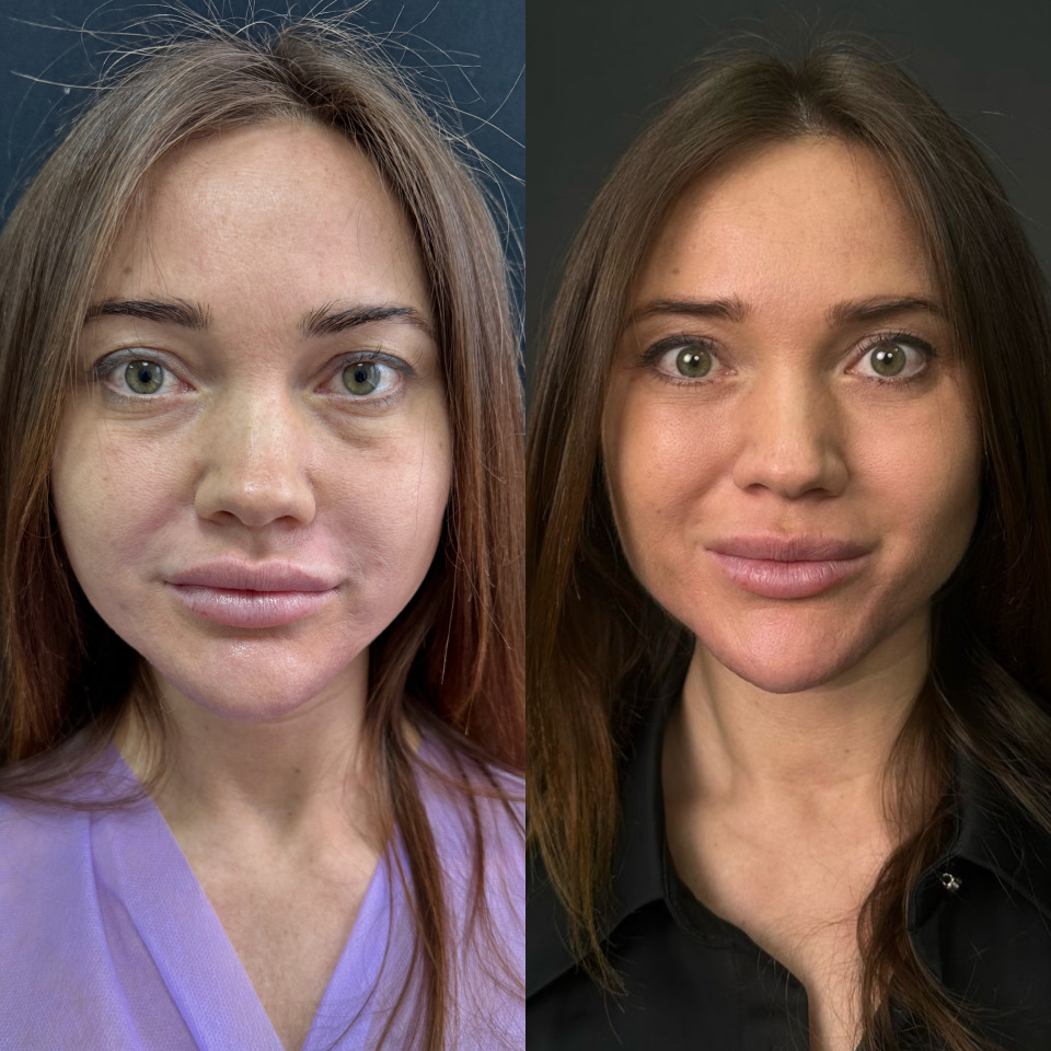Блефаропластика без шва , фотография 1