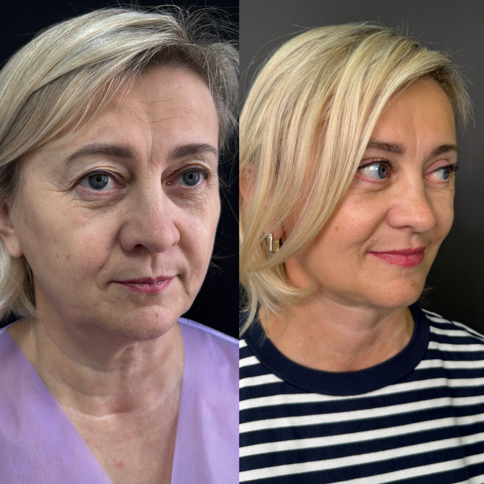 Пластика лица . Фото до и после , фотография 4