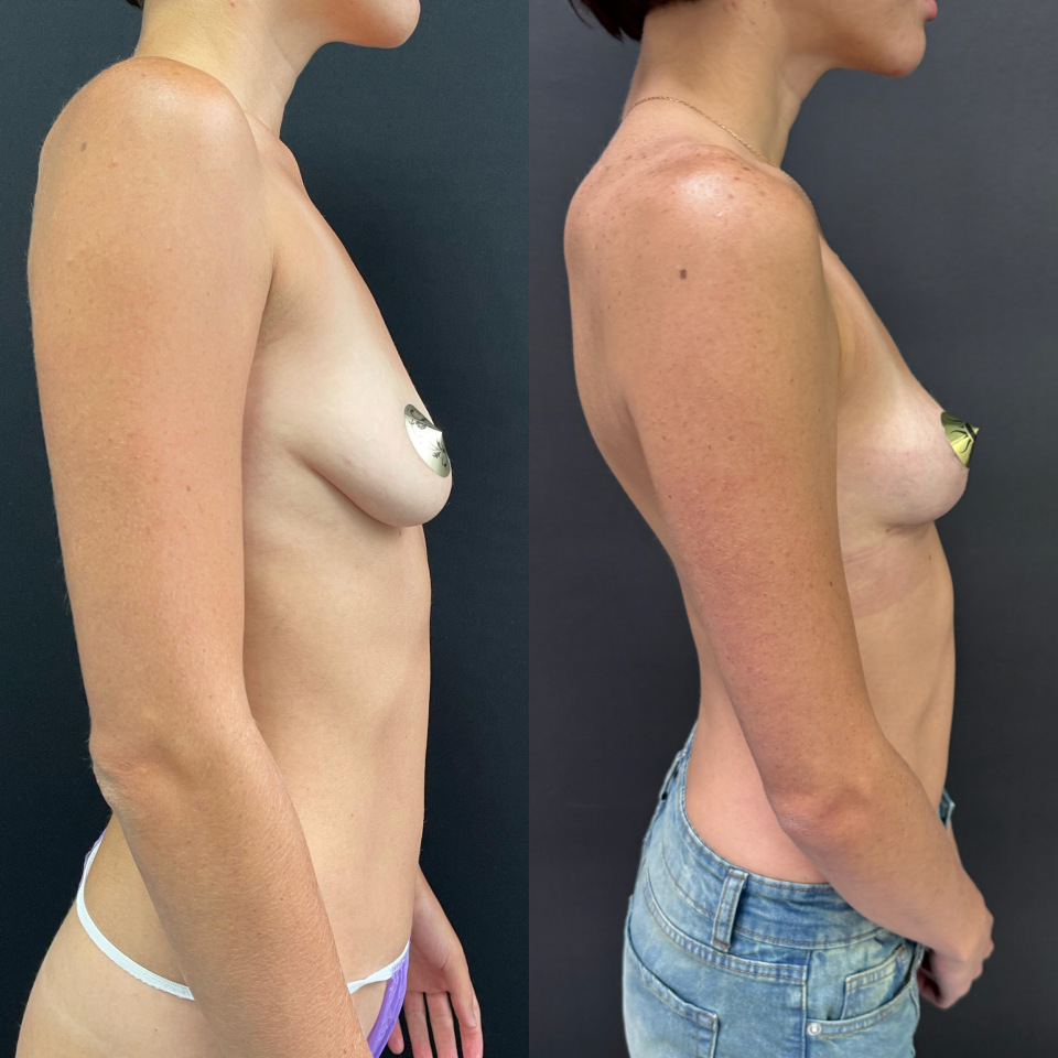 Подтяжка груди без имплантов , фотография 4