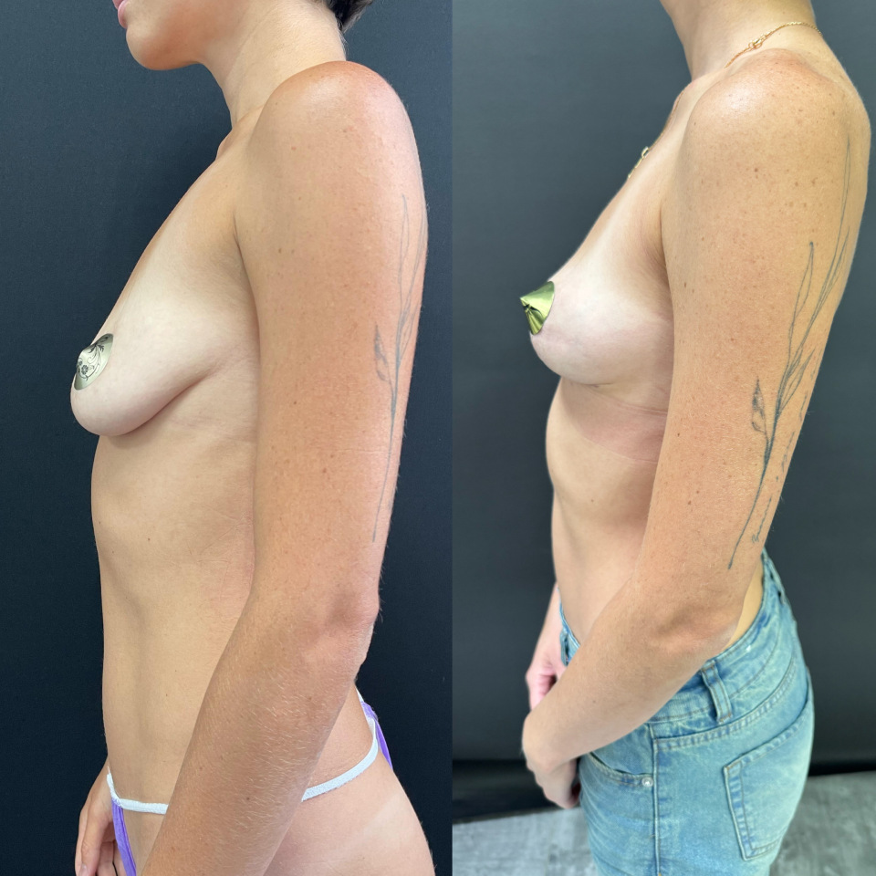 Подтяжка груди без имплантов , фотография 5