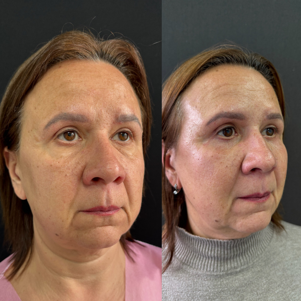 Блефаропластика верхних и нижних век . Фото до и после , фотография 2