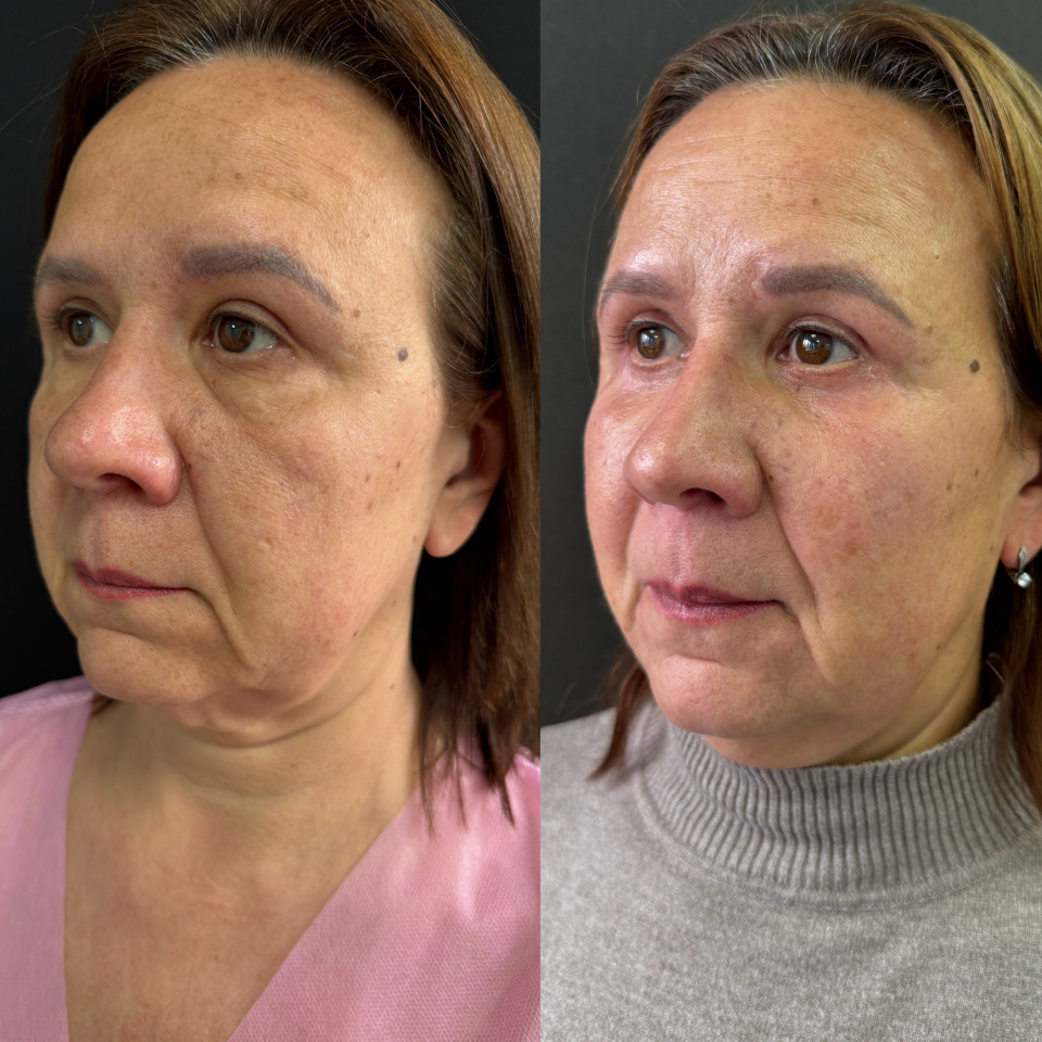 Блефаропластика верхних и нижних век . Фото до и после , фотография 3