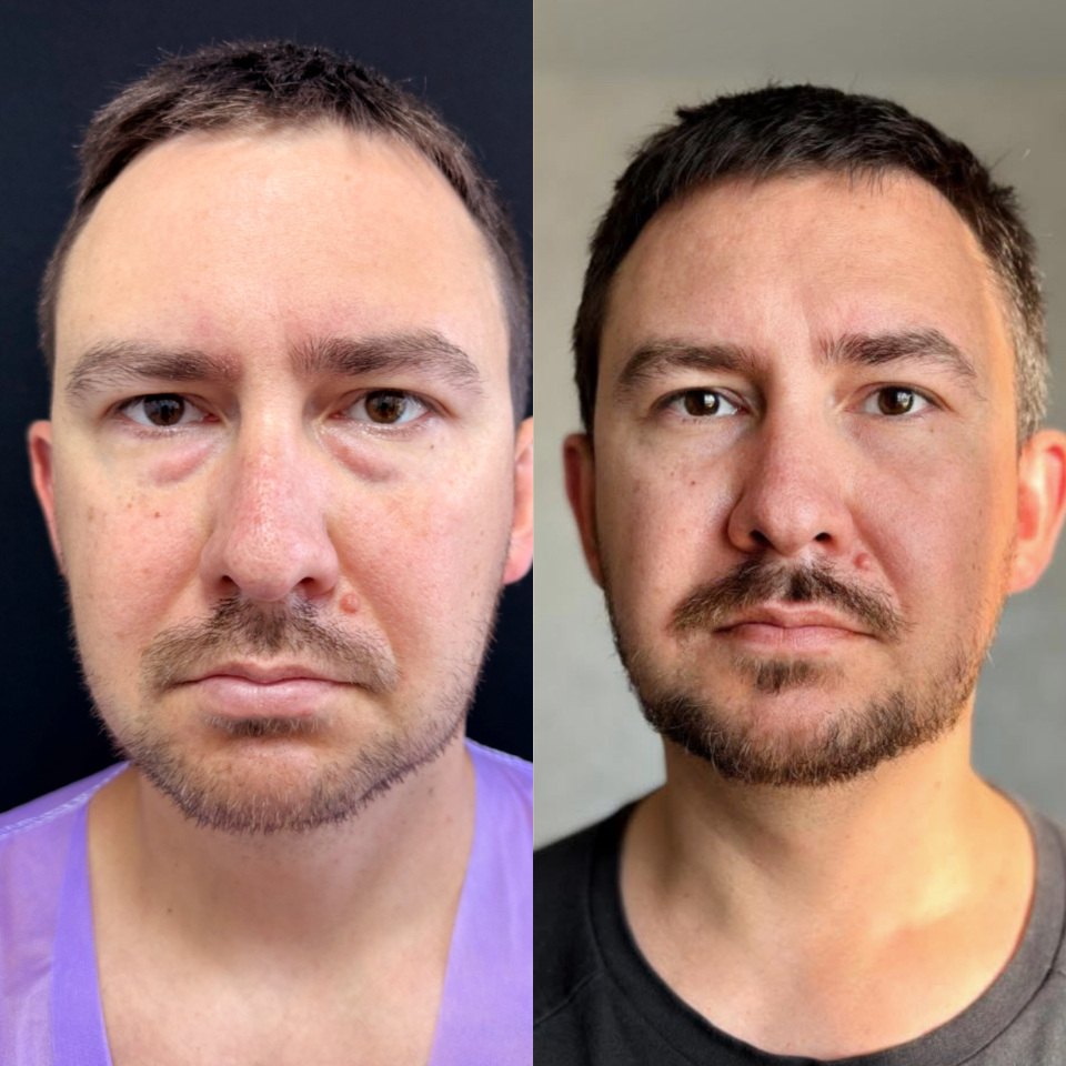 Блефаропластика нижних век . Фото до и после , фотография 1