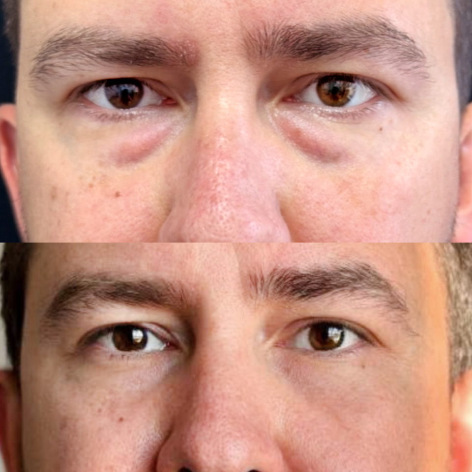 Блефаропластика нижних век . Фото до и после , фотография 2