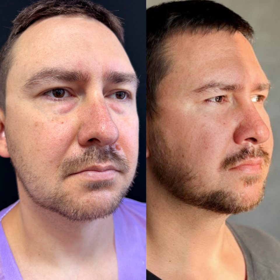 Блефаропластика нижних век . Фото до и после , фотография 3