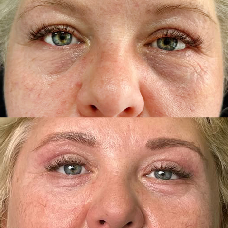 Блефаропластика. Фото до и после, фотография 1