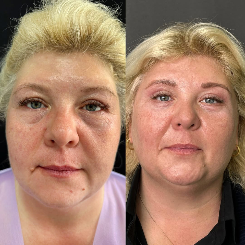 Блефаропластика. Фото до и после, фотография 2