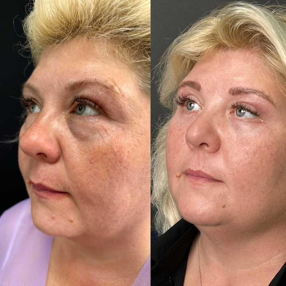 Блефаропластика. Фото до и после, фотография 3