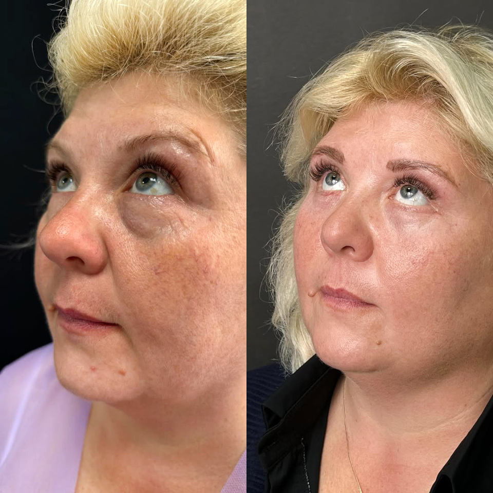 Блефаропластика. Фото до и после, фотография 4