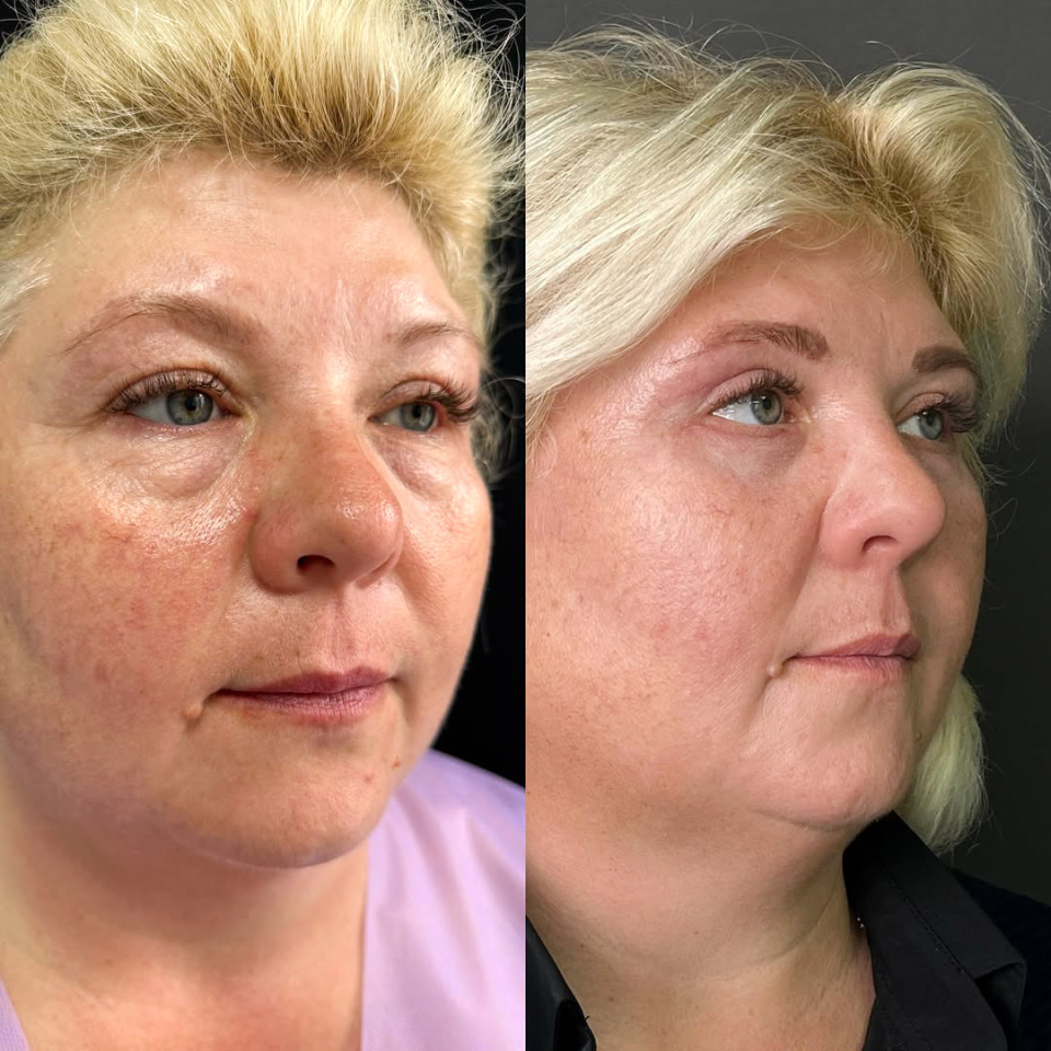 Блефаропластика. Фото до и после, фотография 5