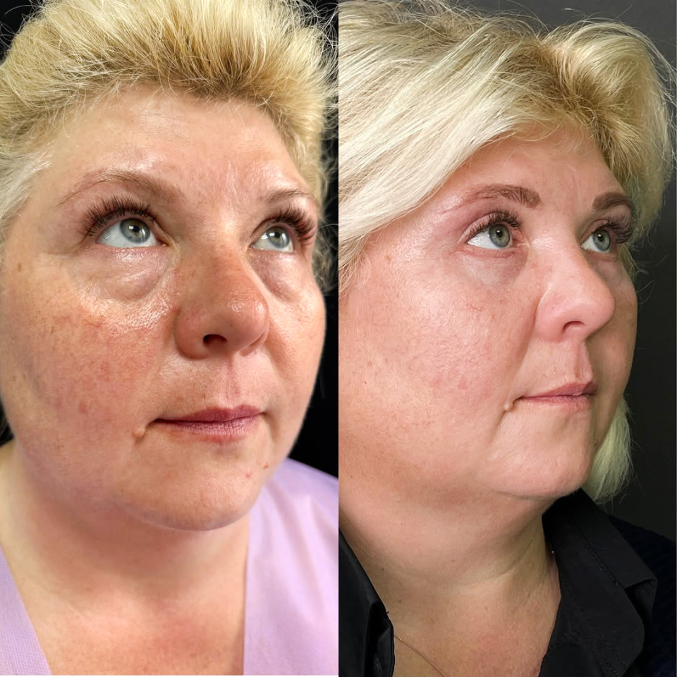 Блефаропластика. Фото до и после, фотография 6