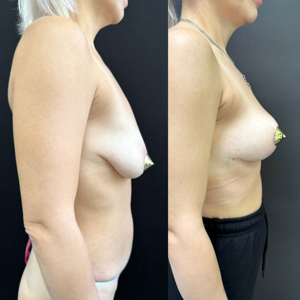 Подтяжка груди. Фото до и после , фотография 4