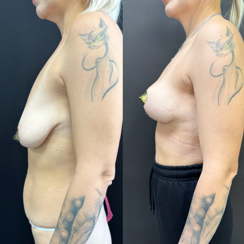 Подтяжка груди. Фото до и после , фотография 5
