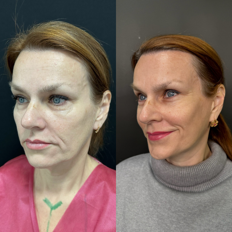 Подтяжка лица. Фото до и после , фотография 1
