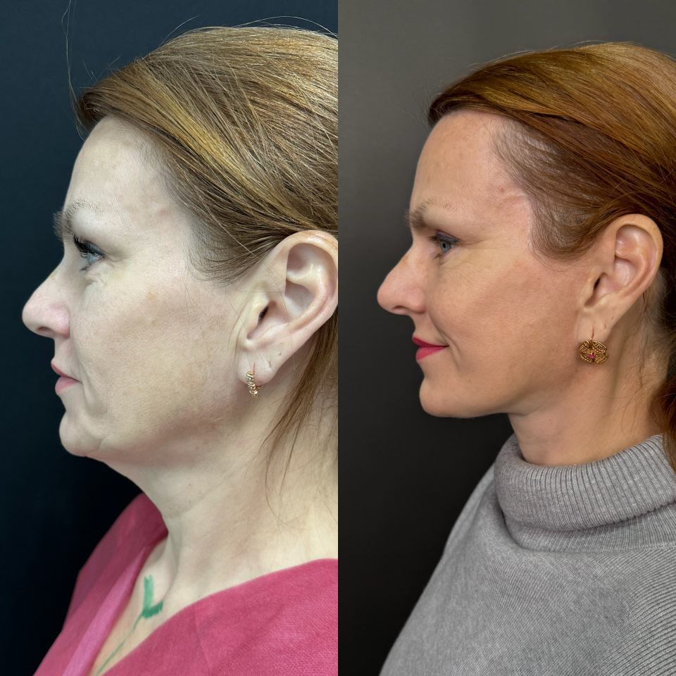Подтяжка лица. Фото до и после , фотография 2