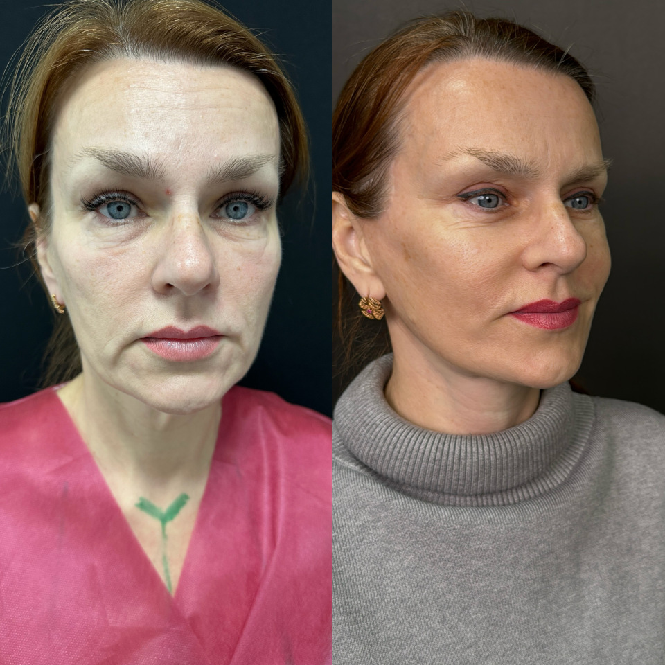 Подтяжка лица. Фото до и после , фотография 3