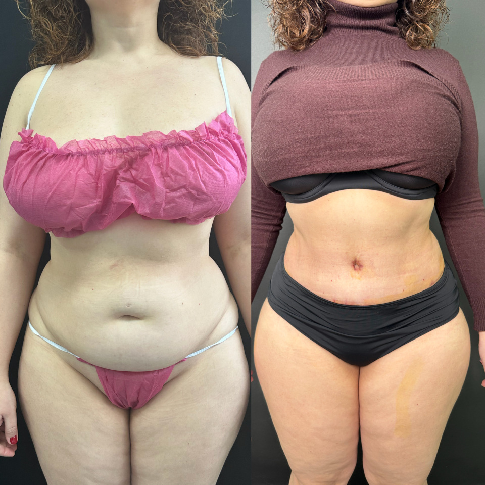 Абдоминопластика. Фото до и после , фотография 1