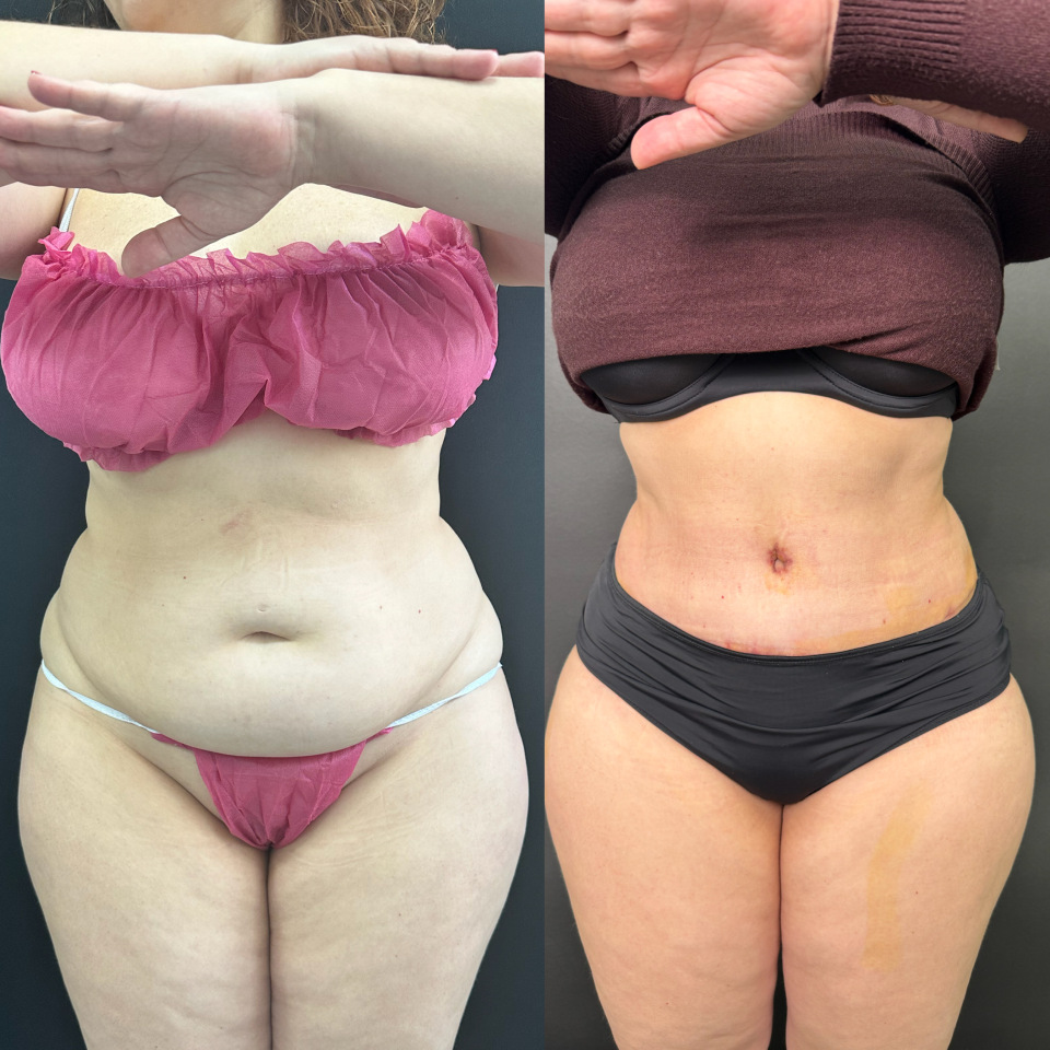 Абдоминопластика. Фото до и после , фотография 2