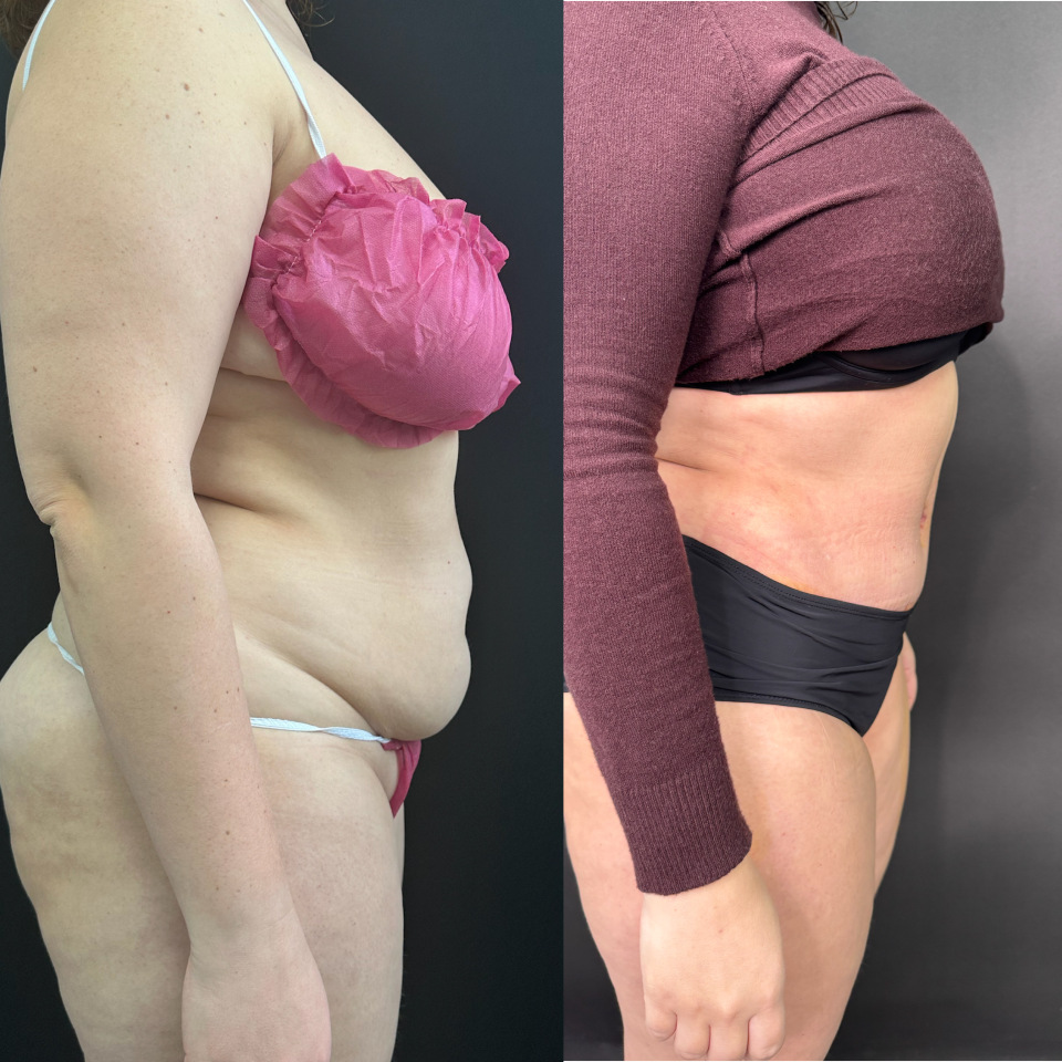 Абдоминопластика. Фото до и после , фотография 3