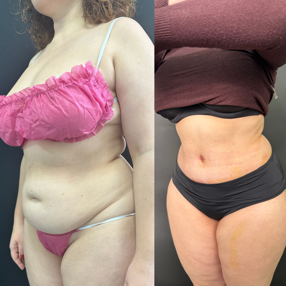 Абдоминопластика. Фото до и после , фотография 4
