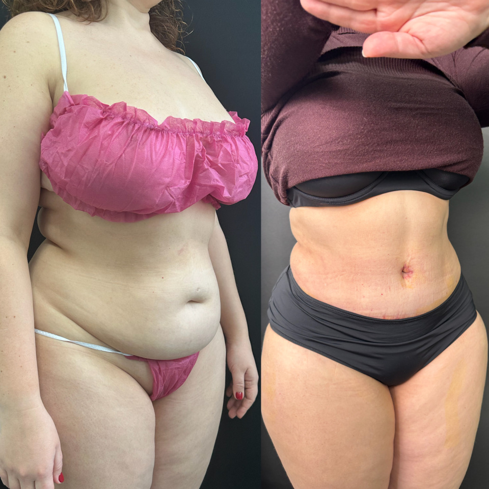 Абдоминопластика. Фото до и после , фотография 5