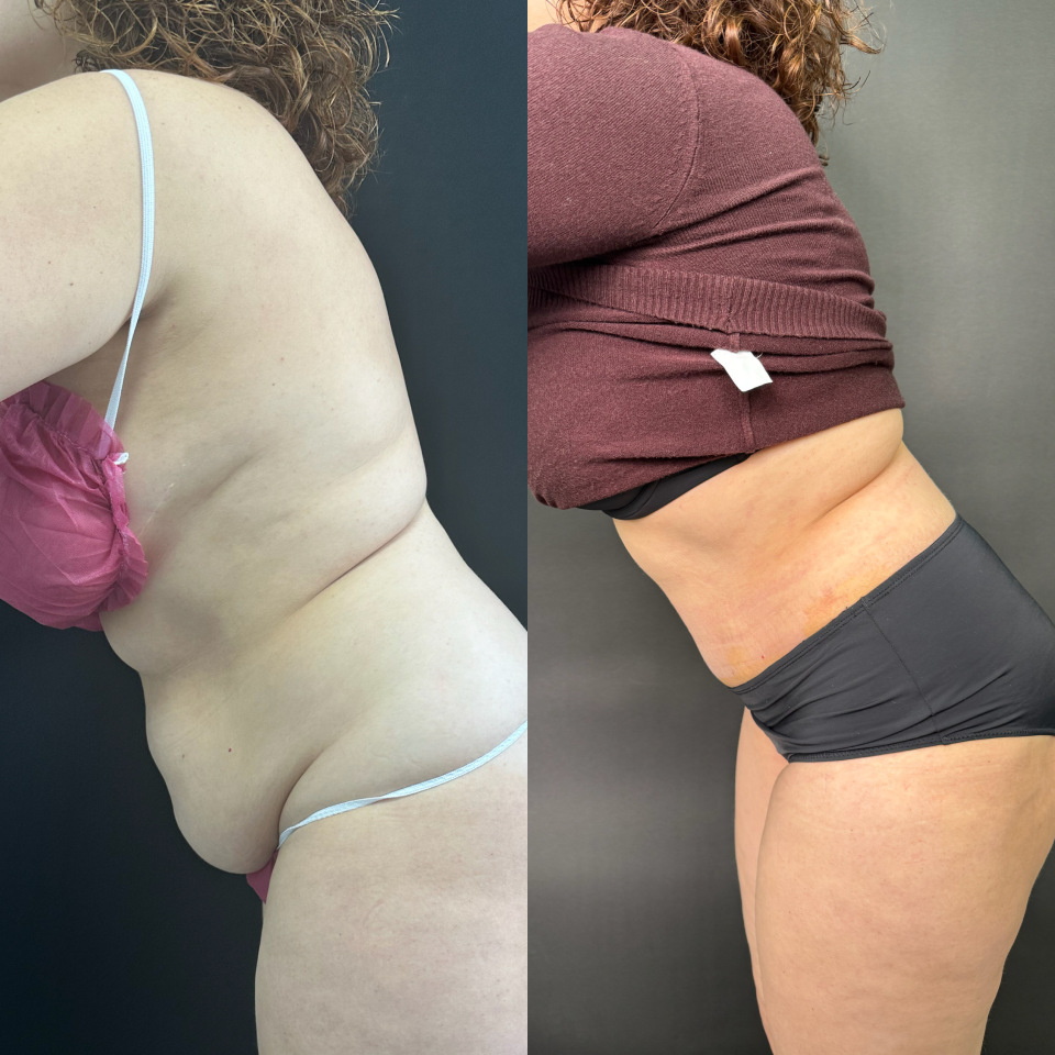 Абдоминопластика. Фото до и после , фотография 6