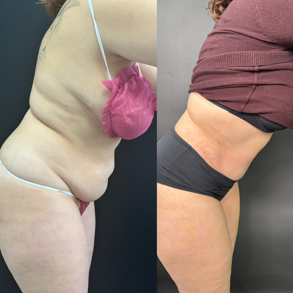 Абдоминопластика. Фото до и после , фотография 7