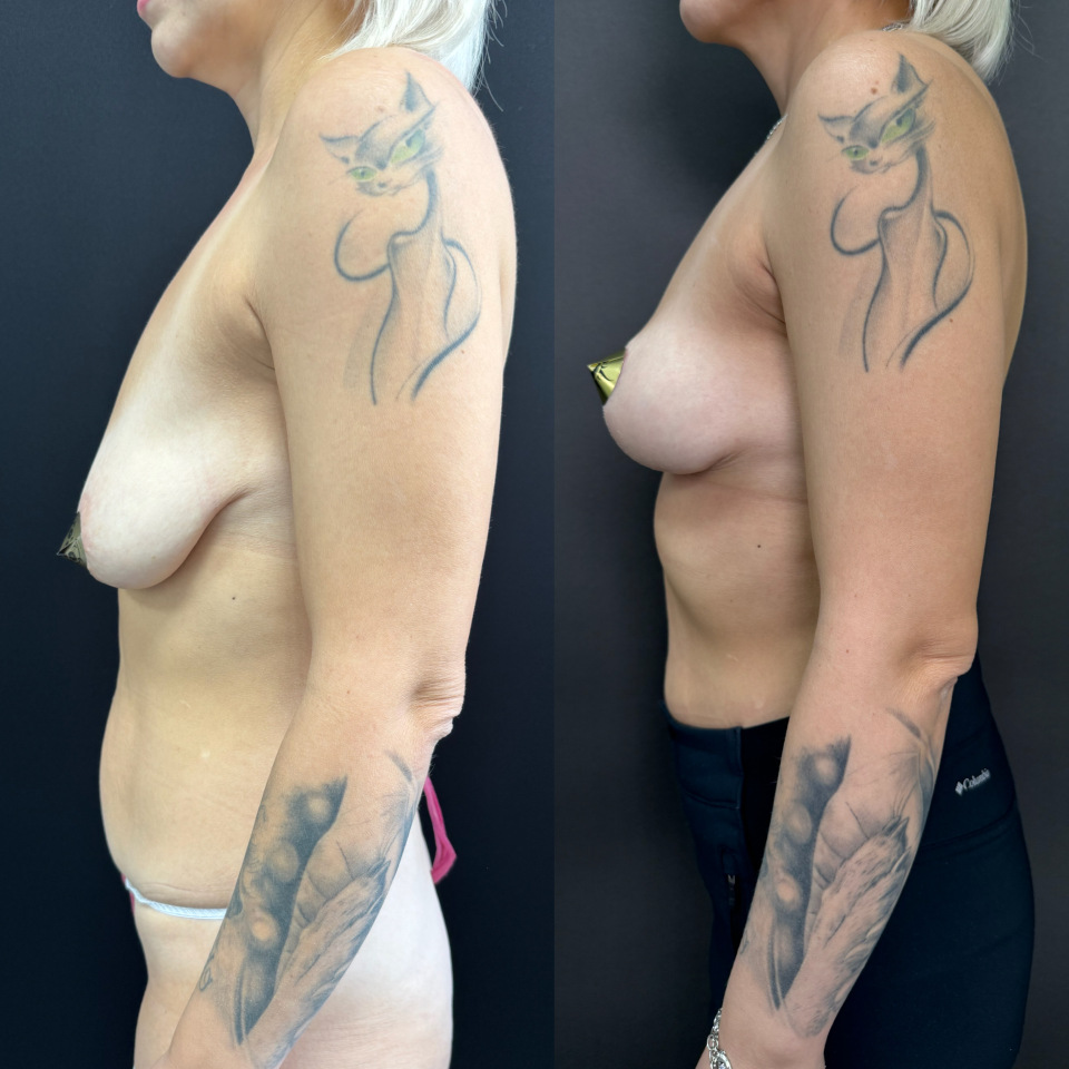 Подтяжка без имплантов . Фото до и после , фотография 3