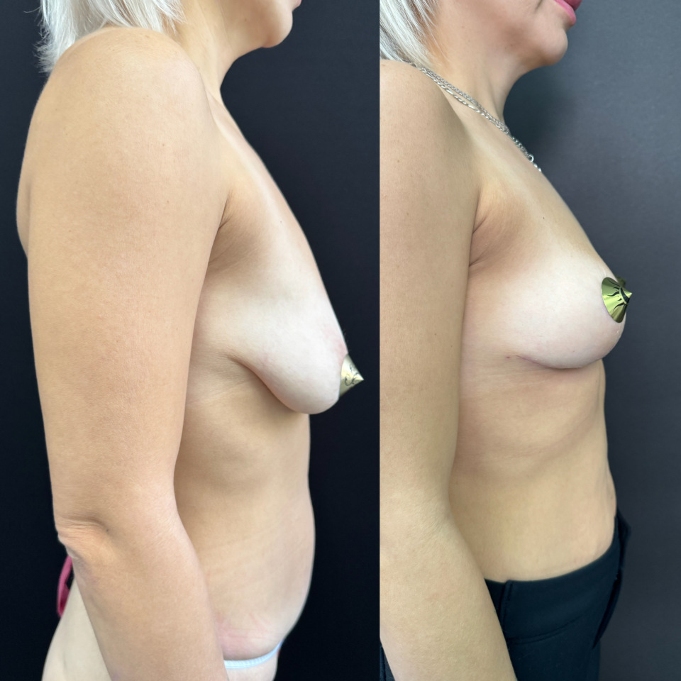 Подтяжка без имплантов . Фото до и после , фотография 5