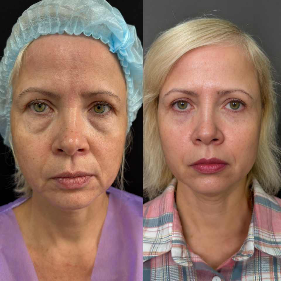Блефаропластика нижних век. Фото до и после , фотография 1