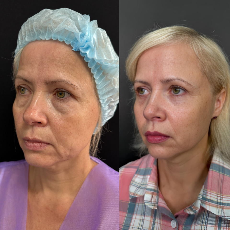 Блефаропластика нижних век. Фото до и после , фотография 2