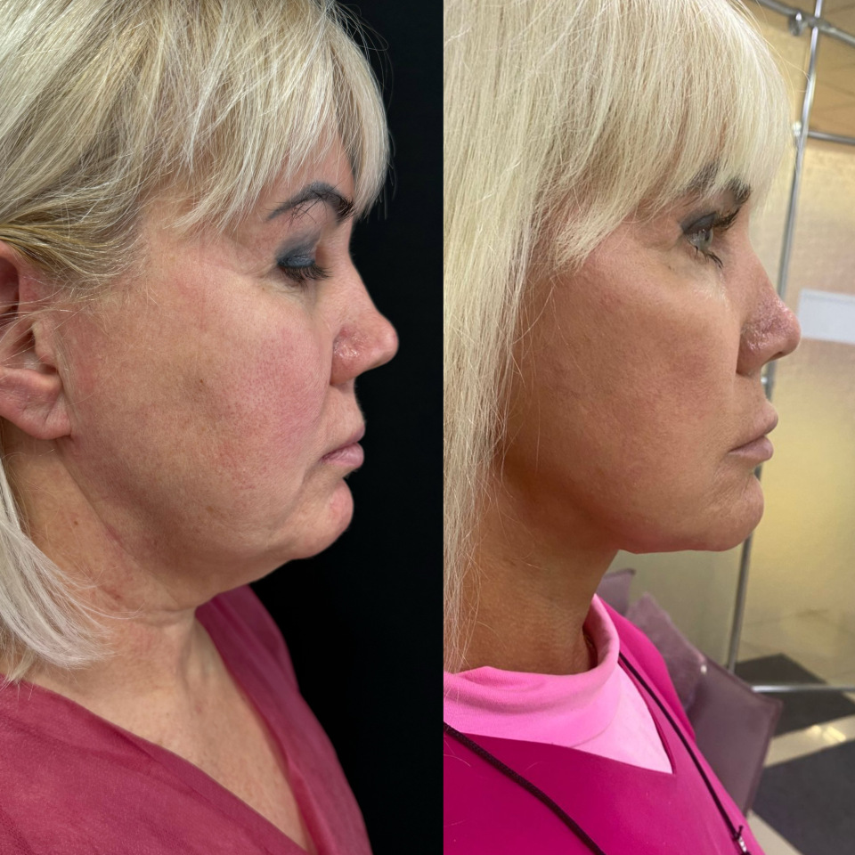 Фейслифтинг . Фото до и после , фотография 1