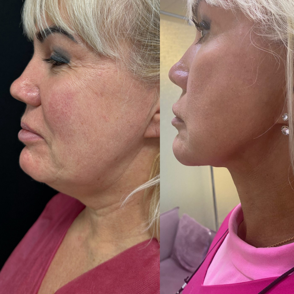 Фейслифтинг . Фото до и после , фотография 2