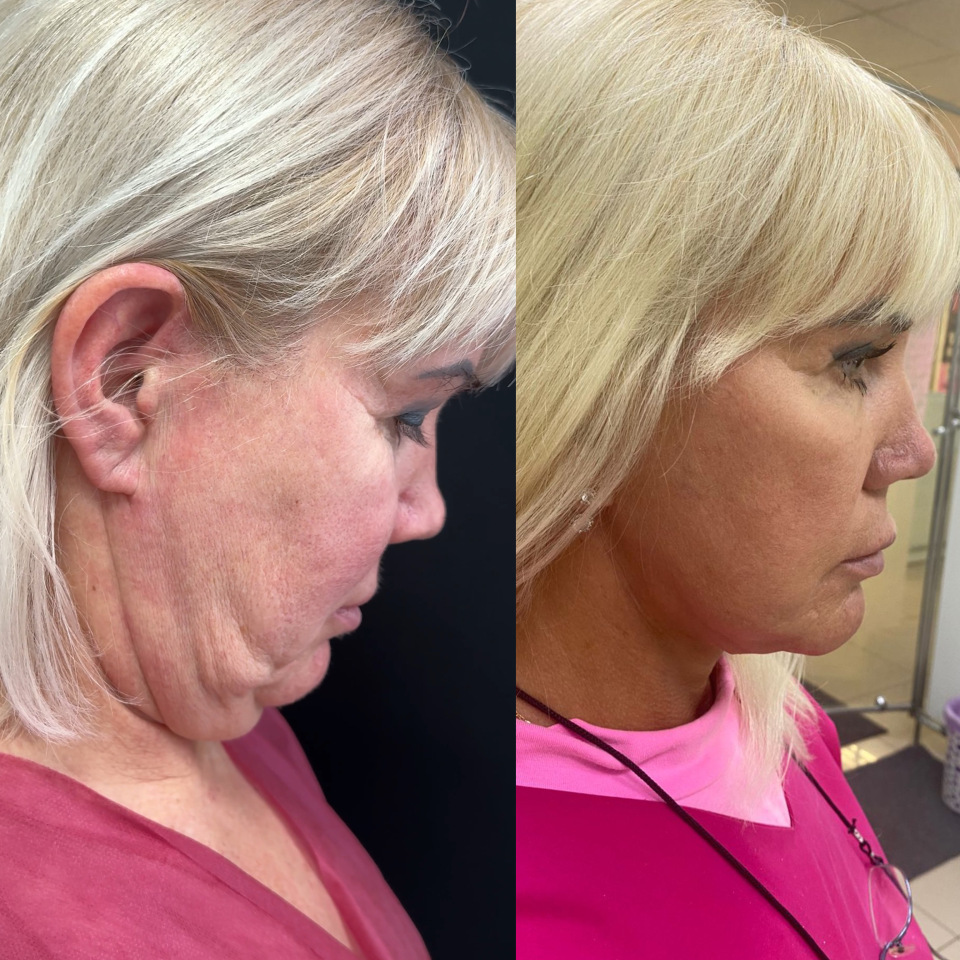 Фейслифтинг . Фото до и после , фотография 3